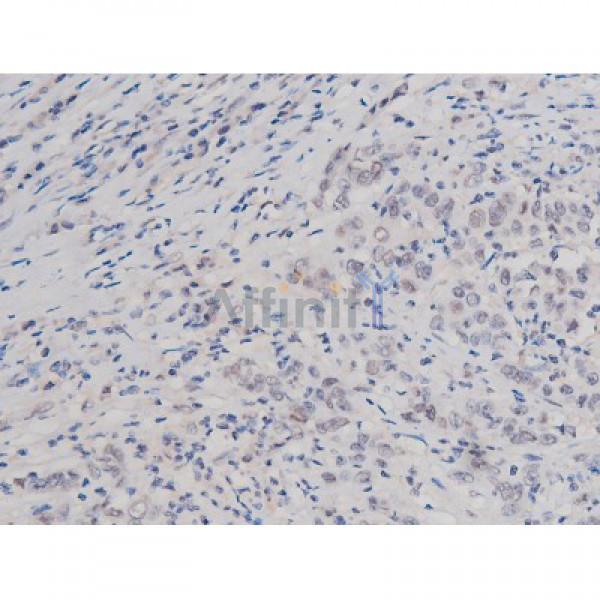 Phospho-Tau (Thr181)[Thr498] Antibody - AF3149 at 1/200 staining Human ganstric cancer tissue sections by IHC-P.